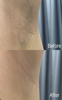 Laser Hair Removal