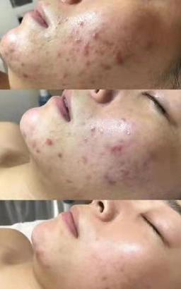 Acne Pimple