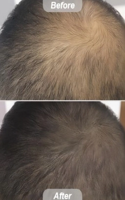 Laser Hair Regrowth Machine