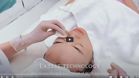 ポータブル真空Microneedling RFマシンのビデオ