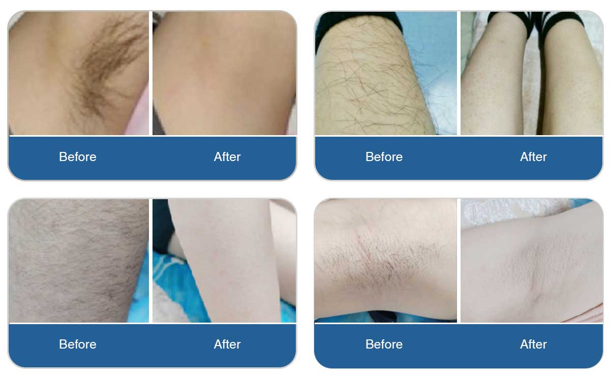 Triple Wavelength Diode Laser Review