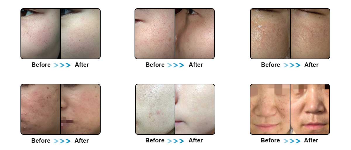 DPL laser machine treatment before and after