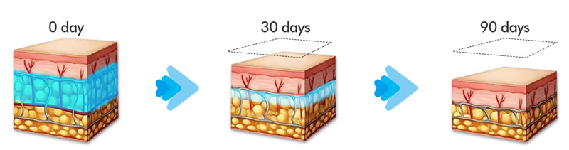 do-fat-freezing-machines-really-work-04.jpg