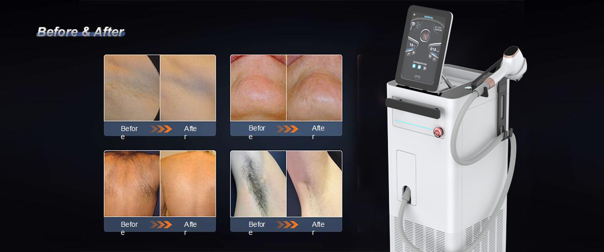 Diode Laser Hair Removal Machine