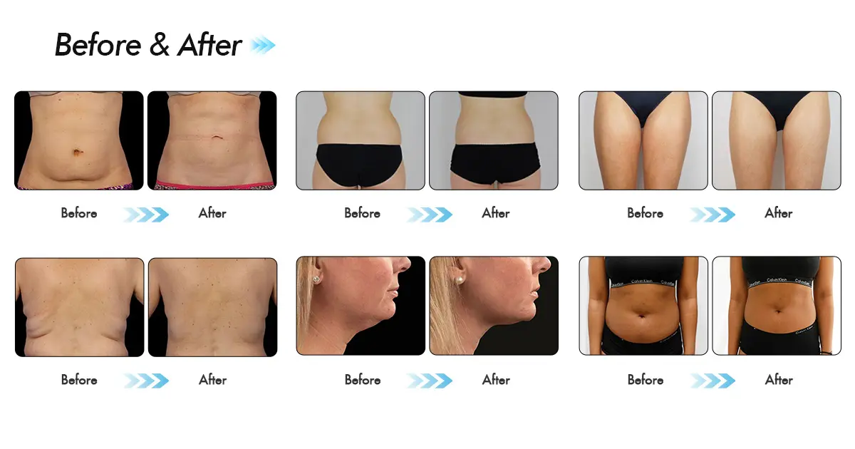 CoolSculpting Upper Arms: 写真の前後