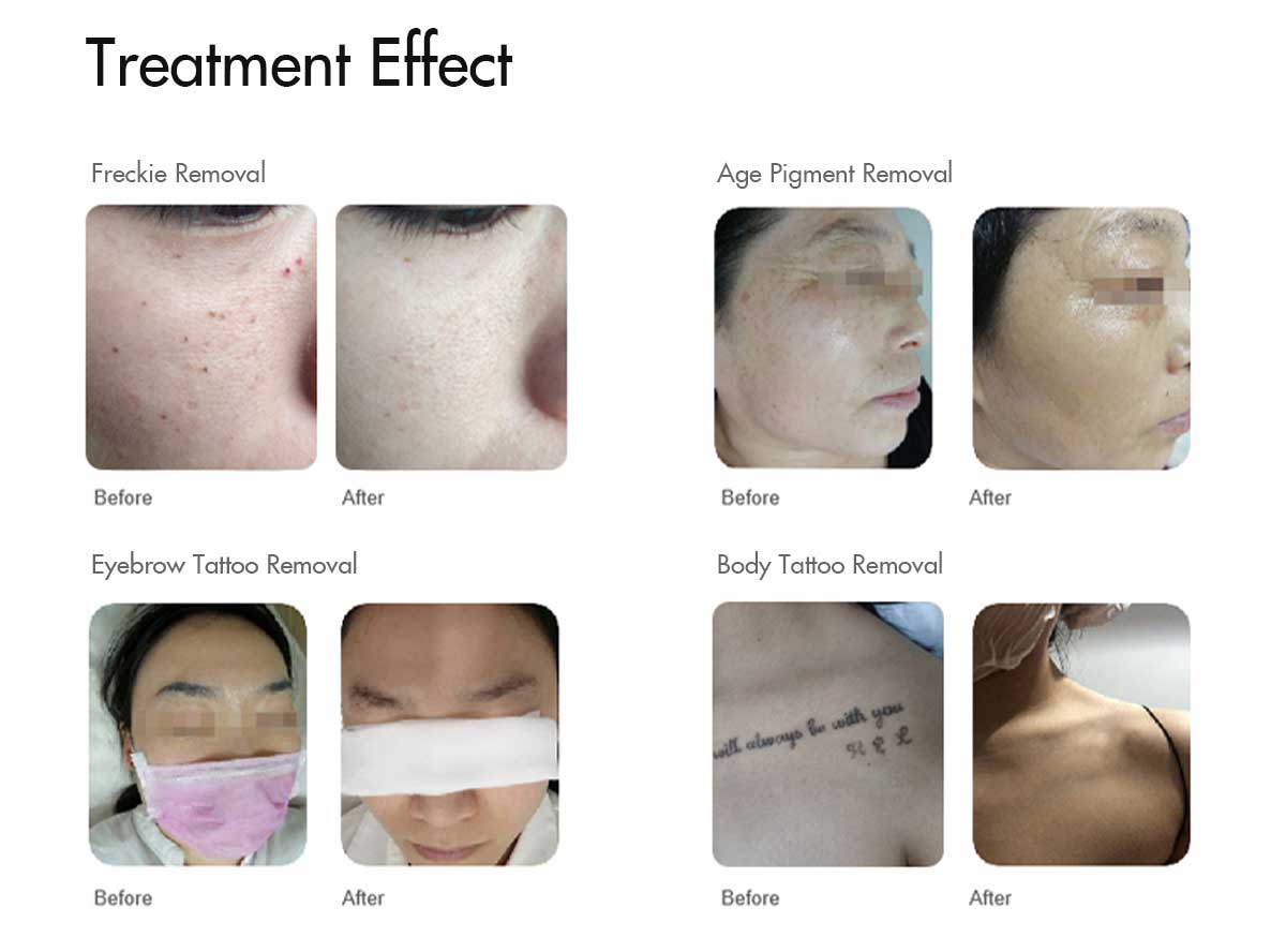 q-switch-laser-treatment-before-and-after.jpg