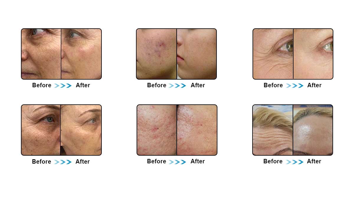 red-spots-after-laser-treatment.jpg