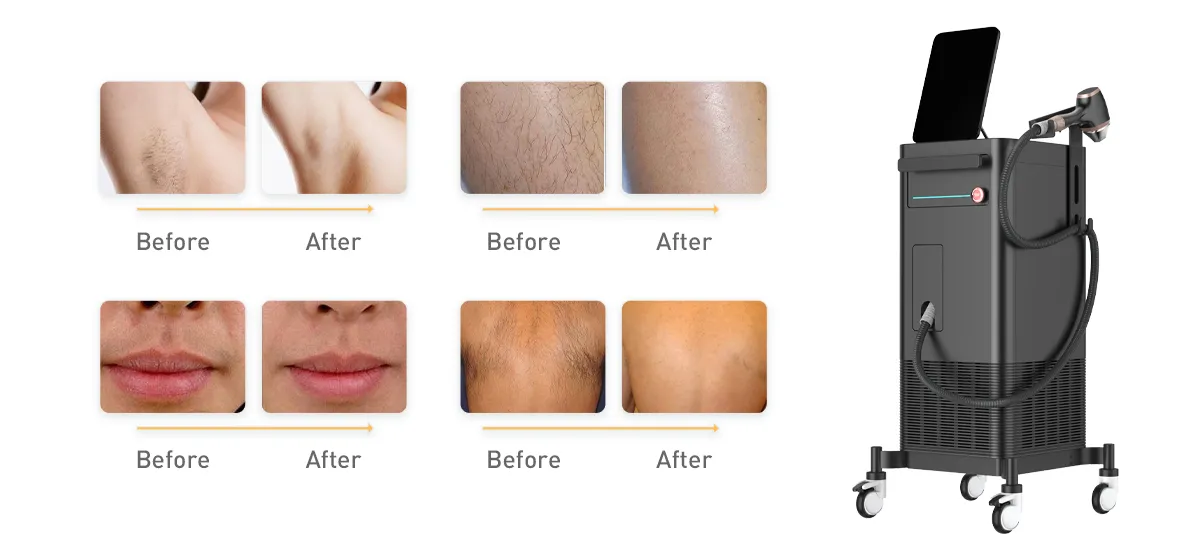 信頼性の高いダイオードレーザー脱毛機サプライヤーの選び方