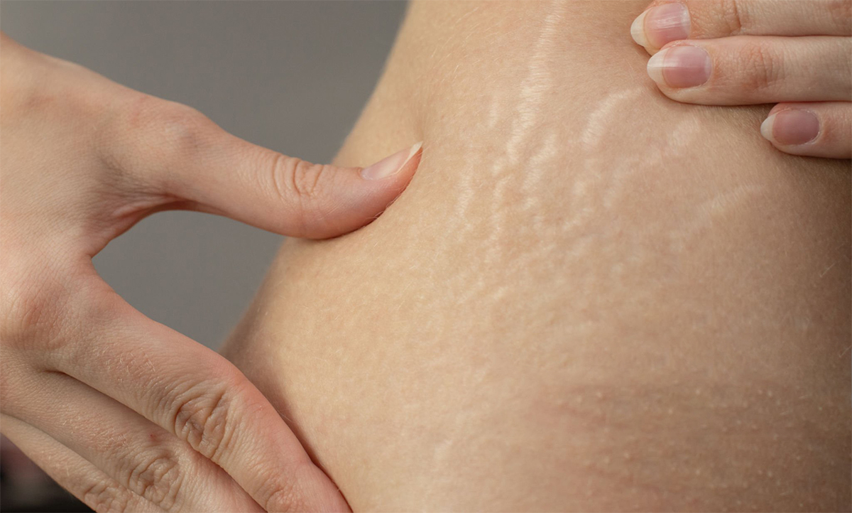 Cellulite.jpg