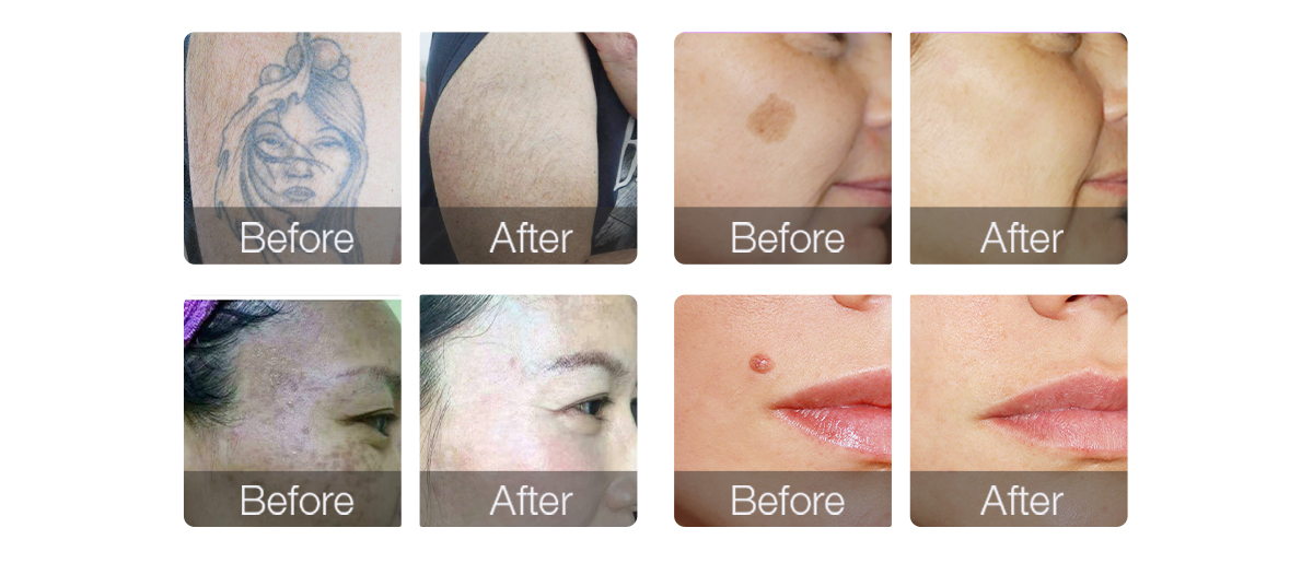 wholesale_picosecond_laser_tattoo_removal_machine.jpg wholesale_picosecond_laser_tattoo_removal_machine.jpg