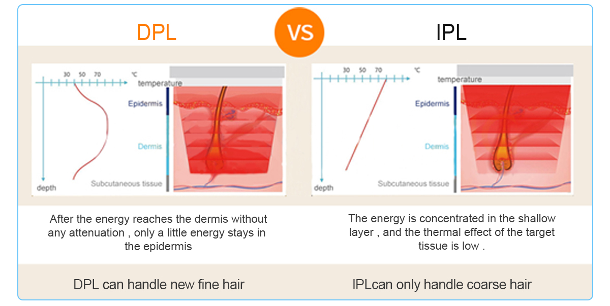 What's the Difference Between DPL and IPL? - 翻译中...